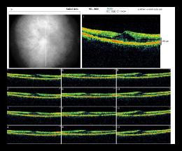 RADIAL LINE OD